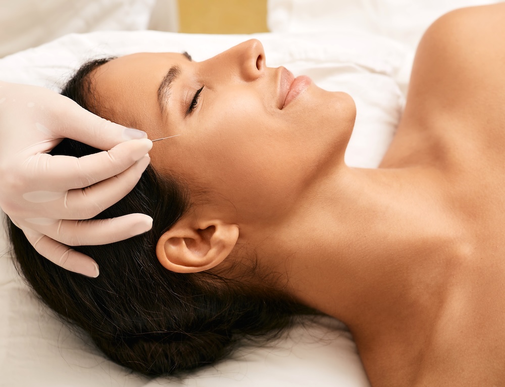 Cosmetic Acupuncture